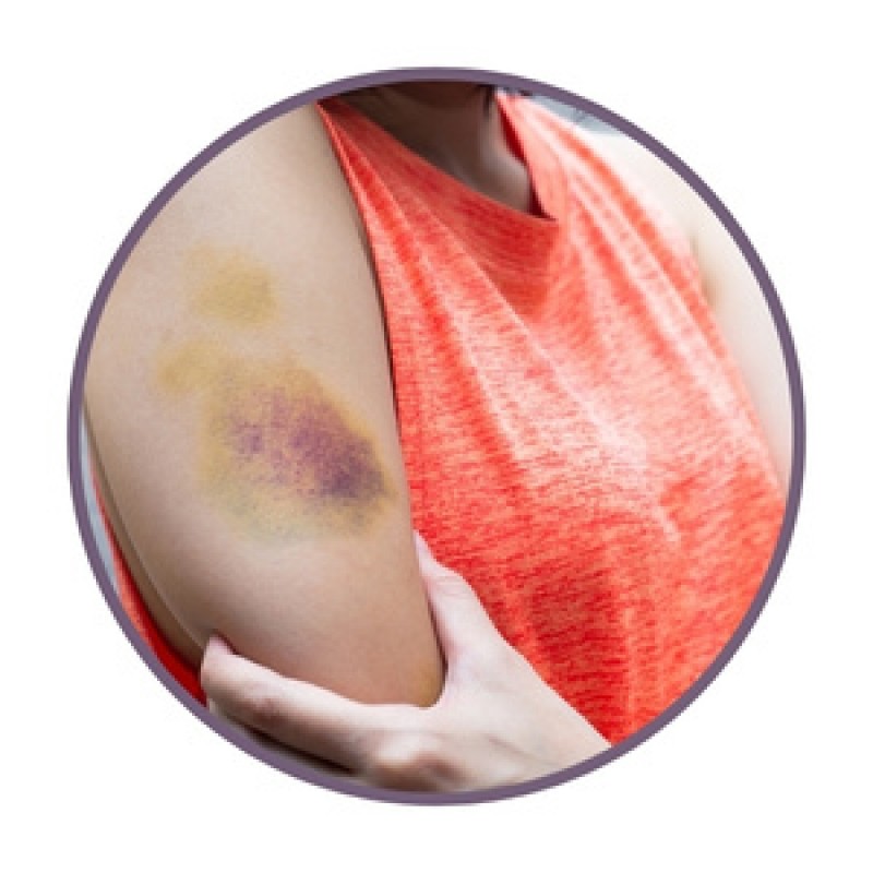 Ointments for bruises