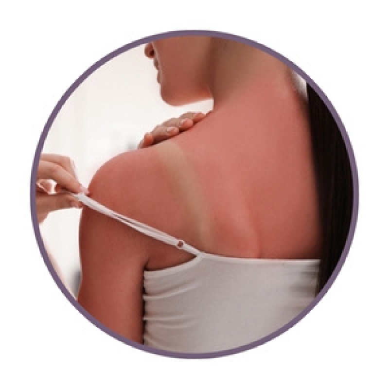 Ointments for burns