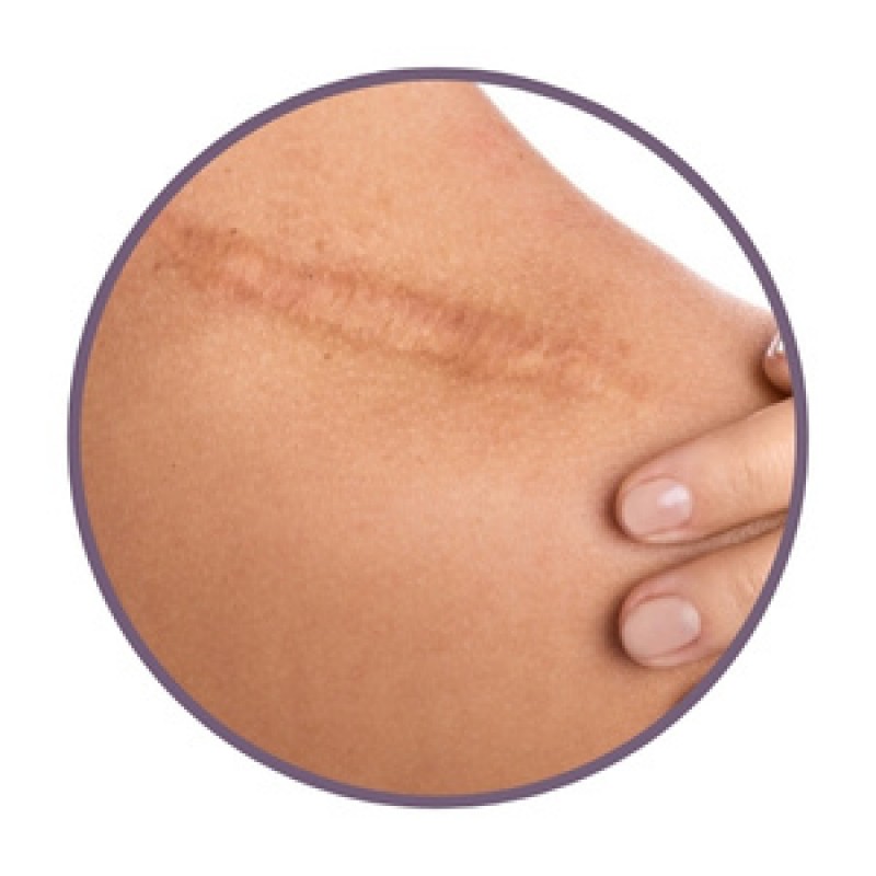 Ointments for scars