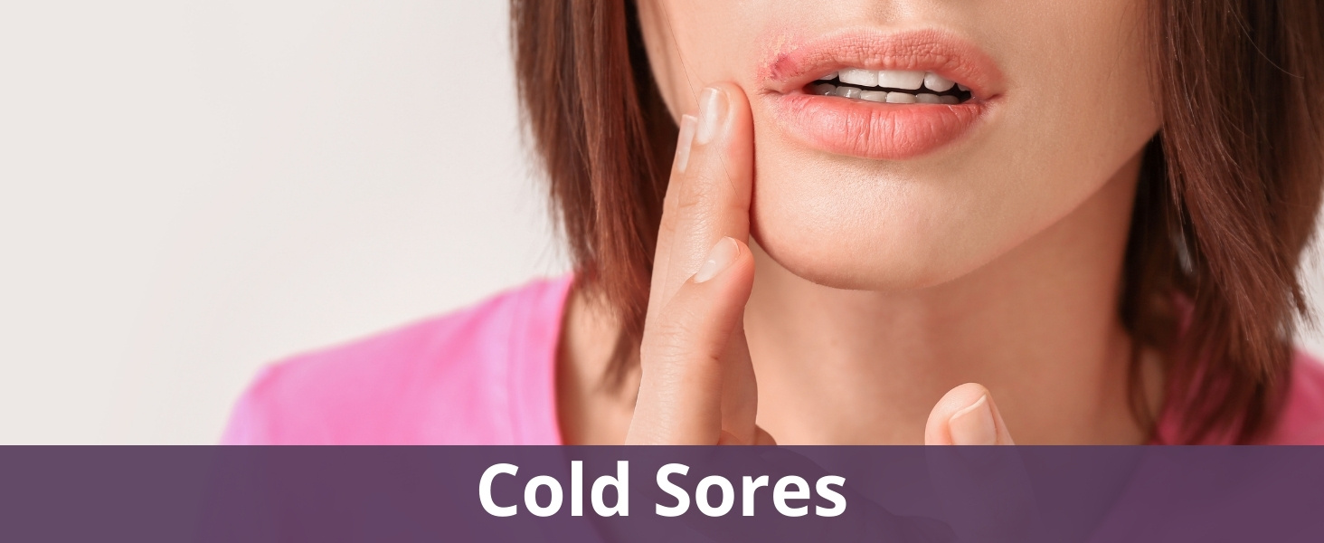 Cold sores