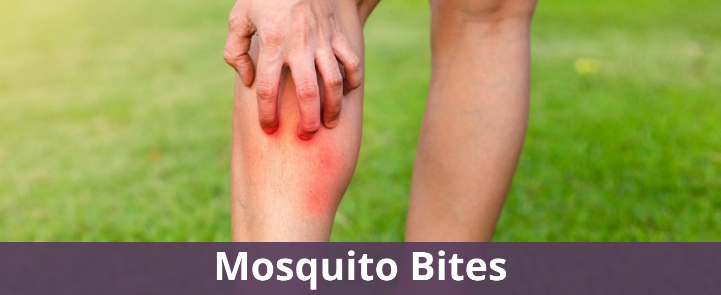 Mosquito bites