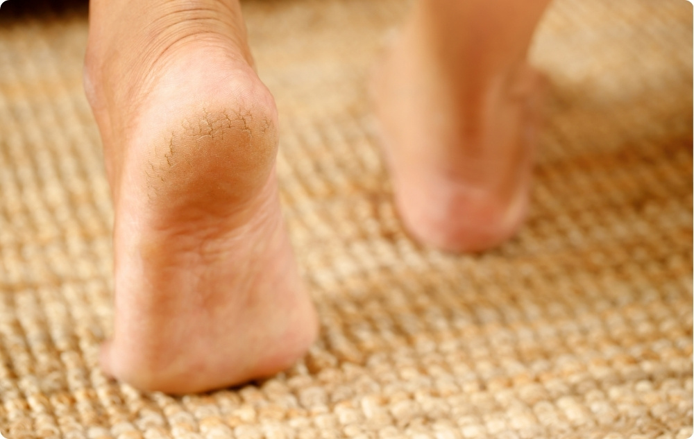 As an oil for cracked heels and rough skin