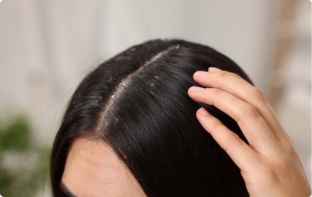 As a scalp lotion for dandruff and itching
