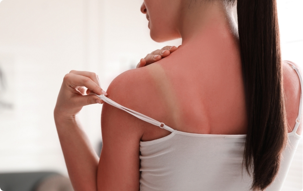 As a soothing after-sun lotion